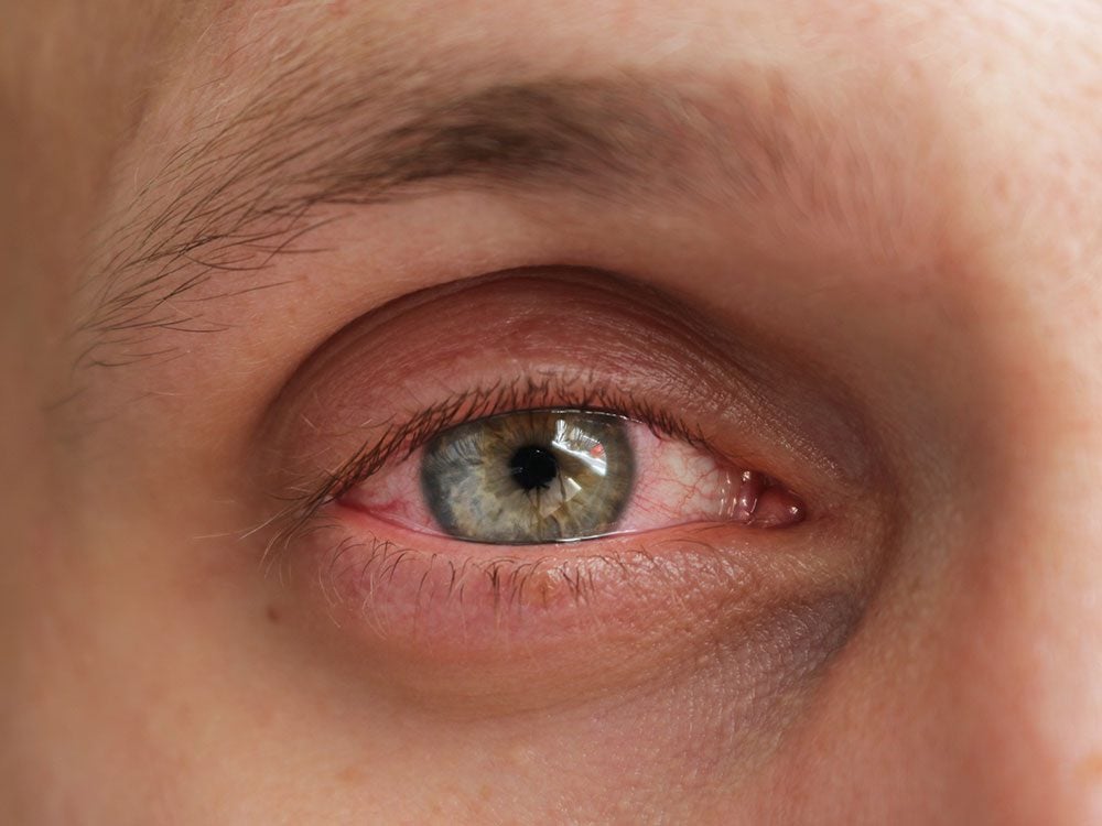 7 Maladies Des Yeux Que Vous Devriez Connaître