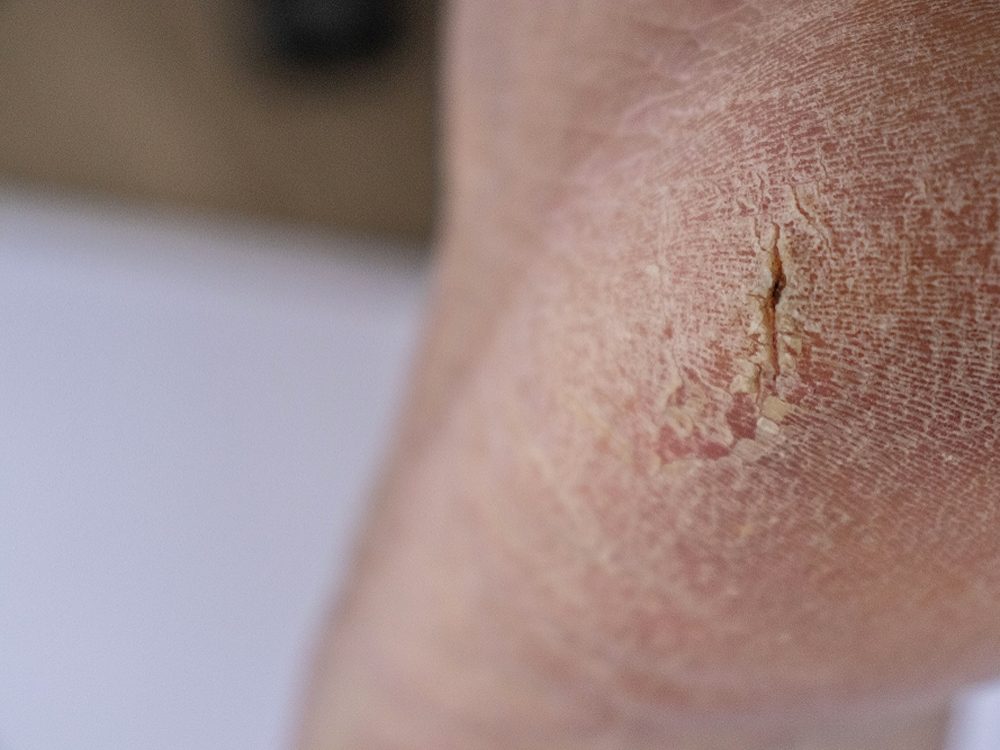 10 Signes Subtils Sur Les Pieds Revelateurs De Maladies