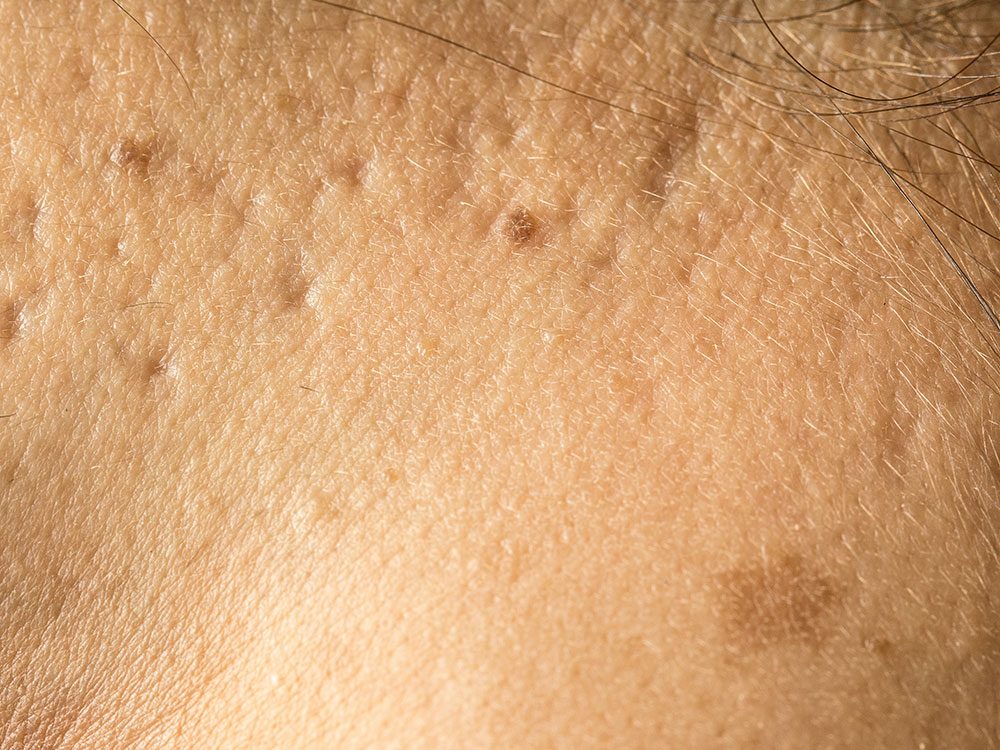 Conseils de dermatologues pour se débarrasser des cicatrices d’acné