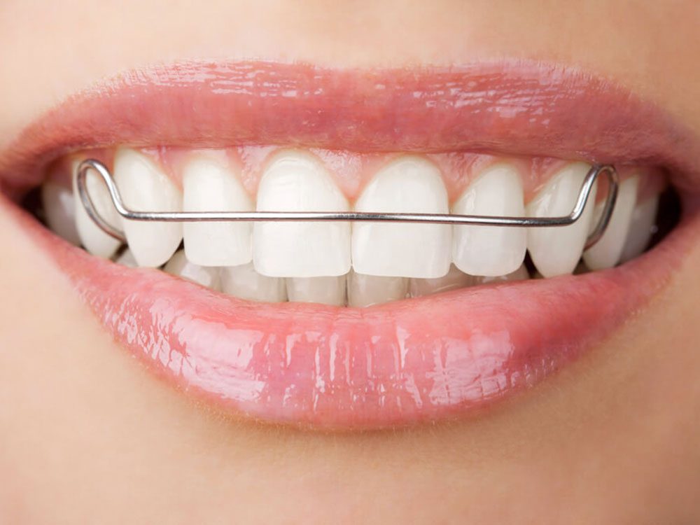 STELIDONT- Réaliser son Appareil Dentaire - Tout Dentaire