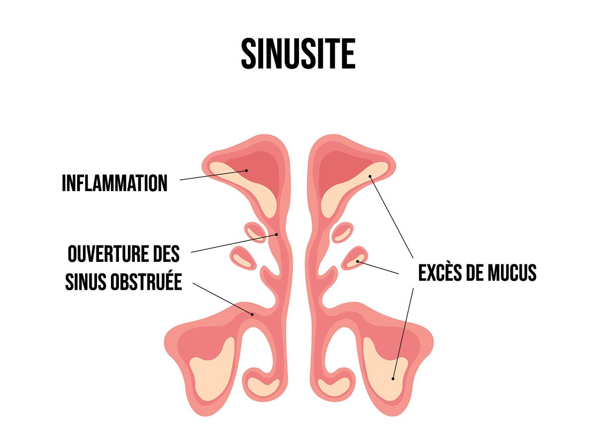 Sinusite : causes, symptômes et traitements (vidéo) - Index Santé
