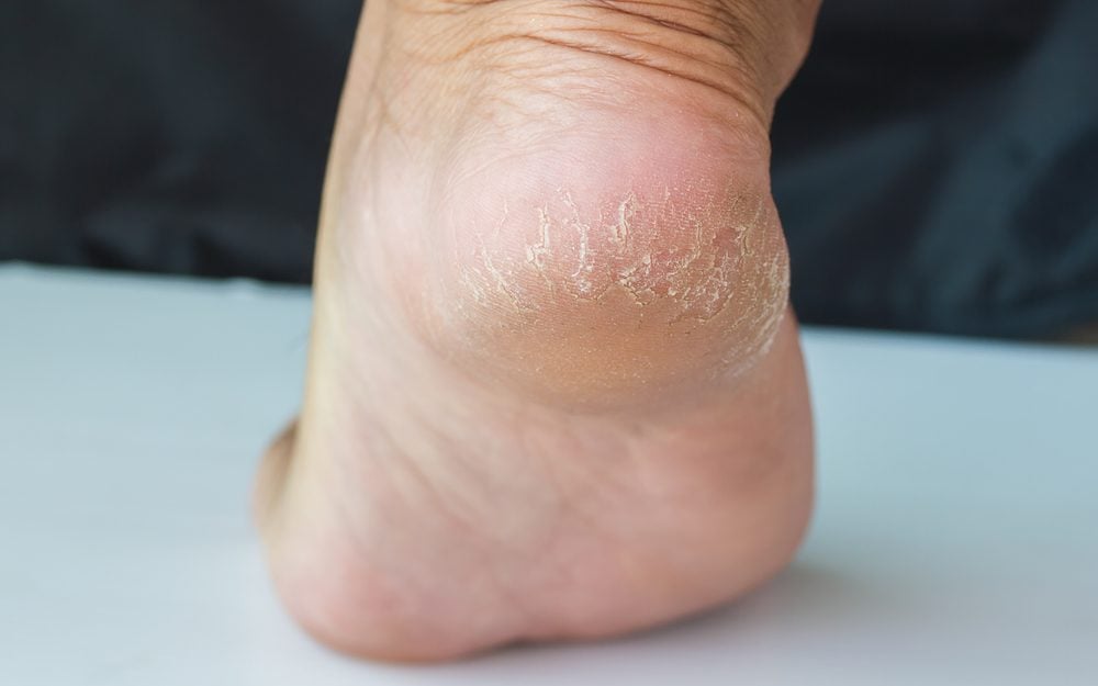 Maladies Des Signes Et Symptômes Visibles Sur Les Pieds